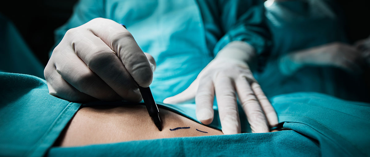 Close up of a plastic surgeon marking the human skin for surgery.